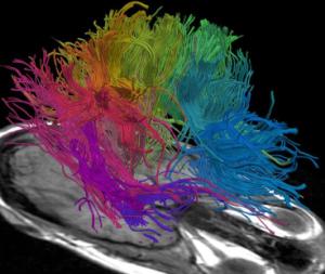 fiber tract clustering in the brain