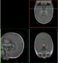 3D slices: 22 MRI baby
brain images after congealing