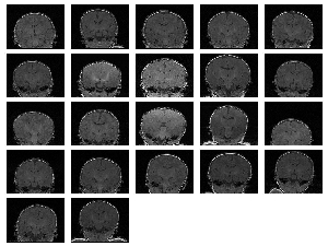 22 MRI baby brain
images