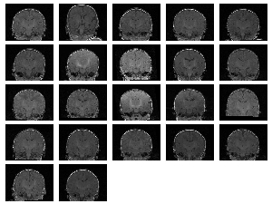 22 MRI baby
brain images after congealing